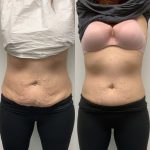 woman's belly fats